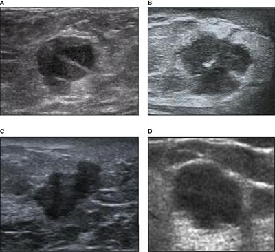 Preoperative Non-Invasive Prediction of Breast Cancer Molecular Subtypes With a Deep Convolutional Neural Network on Ultrasound Images